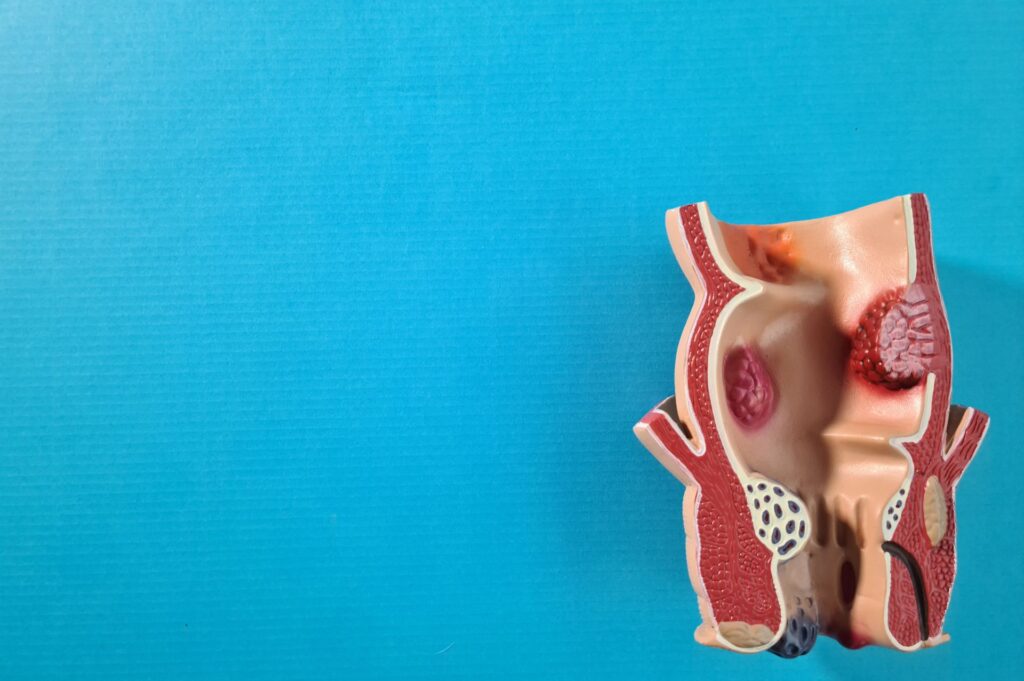 Η Επαναστατική Θεραπεία της Κύστης Κόκκυγα με Laser